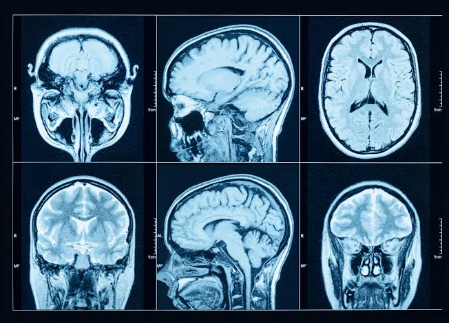 MRI brain scan